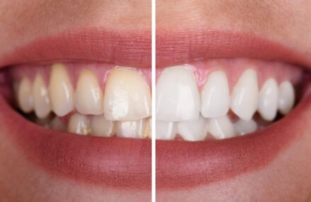Is Dental Anxiety Causing Your Hesitancy Towards Professional Teeth Whitening?