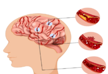 How Endovascular Surgery Strengthens Weak Blood Vessels? Endovascular Surgery