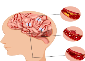 How Endovascular Surgery Strengthens Weak Blood Vessels? Endovascular Surgery